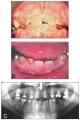 Inherited dentine disorders