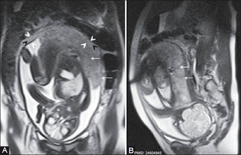 File:MRI placenta uterus upper segment 37 weeks gestation.jpg