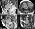 Placenta percreta MRI