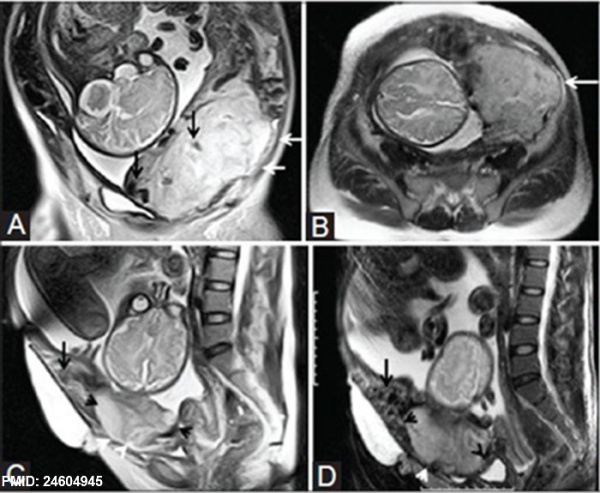 Placenta - Abnormalities - Embryology
