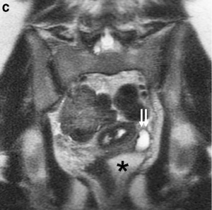 Female genital and ureter abnormality 03.jpg