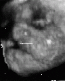 Figure 3. Three-dimensional rendered frontal oblique US image shows a median cleft lip (arrow) in a fetus at 32 weeks gestational age.
