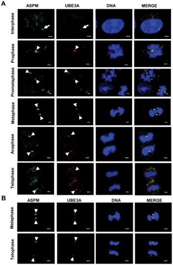 Abnormal cytokinesis and apoptosis in UBE3A knockdown cells.