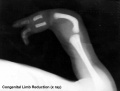 Congenital limb reduction xray