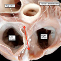 fig 20 Heart patent foramen ovale