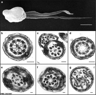 Human sperm pathologies EM01.jpg