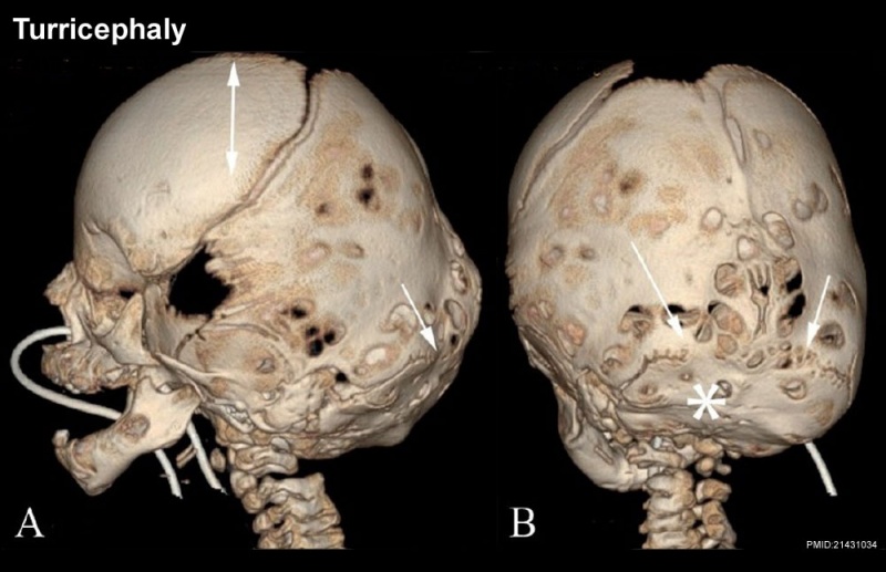 File:Skull CT abnormal 04.jpg